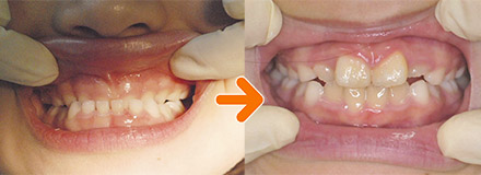 小児の歯列矯正